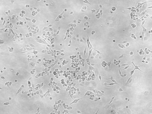 magnification of cancer cells