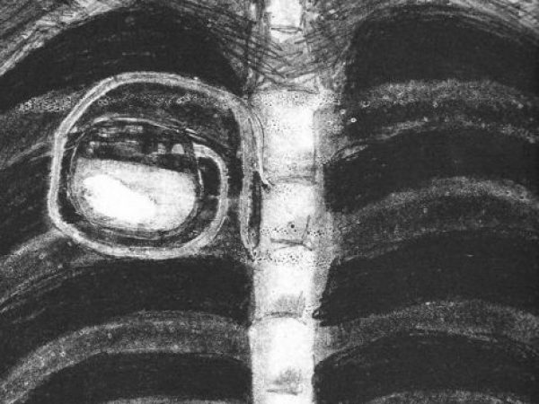human chest with pacemaker lithograph