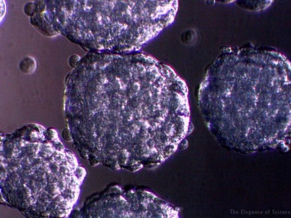 sample of brain cancer cells