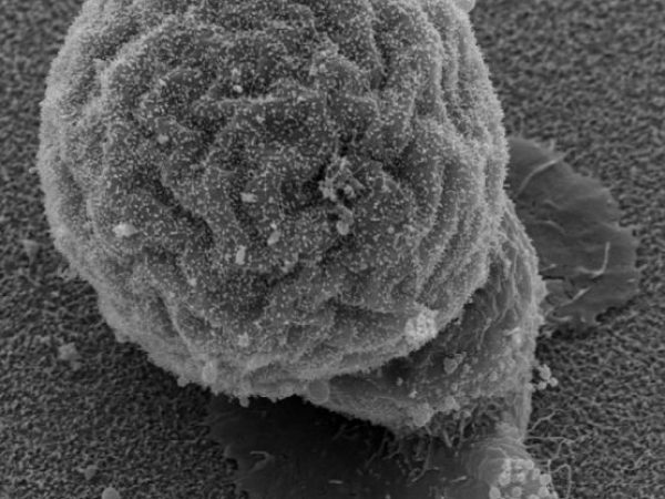 magnification of esophageal cancer cells