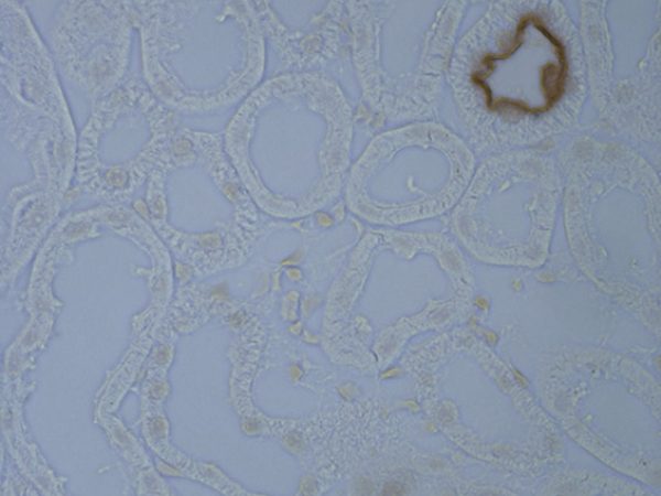 Nephron Staining by Kristen Solocinski: The kidney is able to filter our blood through the actions of the nephron, the functional unit of the kidney. The nephron is shaped like a bendy straw with filtrate on the inside and the walls of the straw representing a single layer of epithelial cells. This image shows many nephrons in a cross-sectional view. In the top right corner are two nephrons showing staining (in brown) for a specific sodium transporter. This transporter is located on the filtrate-facing or apical side of the cells so it can take sodium from the filtrate and return it to the blood. This heterogeneity of the nephron is highlighted by the selective staining of the transporter only in a few cross sections. In a much lighter brown you can see staining of nuclei of individual cells. This image beautifully depicts complexity and beauty of the kidney that you might not expect.