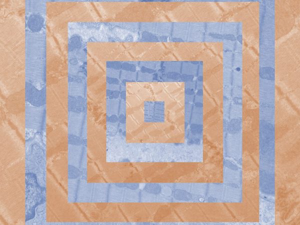 Mitochondria truly are powerhouse of the cell as they create the energy that our body requires to do almost everything. Each individual image is taken from a sample of heart tissue from Boxers and through electron microscopy, it enables us to see the inner portion of the mitochondria. The disease that I am researching is known as Arrhythmogenic Right Ventricular Cardiomyopathy (ARVC). It involves fatty, fibrous infiltration of heart tissue which ultimately causes an arrhythmia. The color of each square is pertinent as it indicates those who were and those who were not affected by ARVC. The orange squares represent those affected and blue represent those unaffected. If looked at closely, then one can see the structural differences amongst the orange squares compared to the blue. As separate entities, they are merely colored squares, but together they create a beautiful, powerful, geometric mosaic.