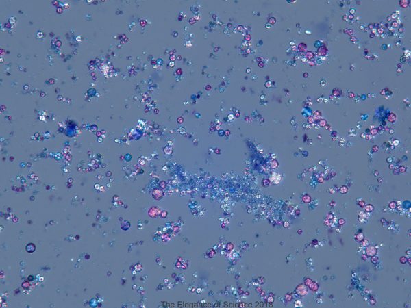 This is a urine sediment preparation of a healthy Sulcata tortoise showing variably sized radiant spheres consistent with urate crystals. These crystals are excreted to remove nitrogen-containing wastes from protein digestion. The presence of these crystals is a normal finding when examining urine from reptiles and offer a beautiful view through the microscope when polarized.