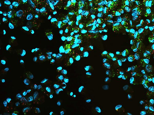 The beautiful cells shown in this picture are fibroblasts that have been genetically engineered to act as heart cells in Doberman Pinschers with dilated cardiomyopathy (DCM), a deadly disease. The vibrant, fluorescent colored dots in the image are both encapsulating and scientifically relevant. They represent segments of the RNA of the PDK4 gene, the gene responsible for causing dilated cardiomyopathy. The red colored probe attaches to the beginning of the gene, while the green colored probe only attaches if the gene has the disease producing mutation. The yellow color is created by overlapping of the green and red colors. The fibroblasts above are from a Doberman Pinscher that is heterozygous for the PDK4 mutation, creating the magnificent mosaic of colors. This image is not only one step in groundbreaking research to create a gene therapy to prevent DCM in Dobermans, but also fully displays the elegance of science.