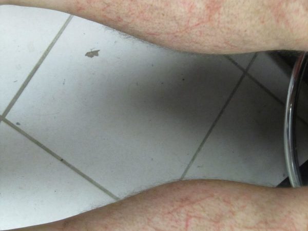 close up of John's legs covered in scratches