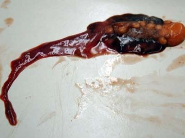 Removed ovary, eggs, and epigonal tissue.