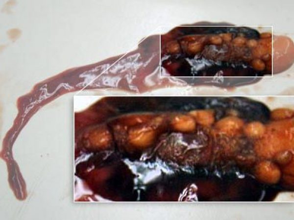 Close up: removed eggs.