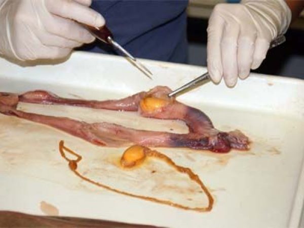 Dissector removing a fertilized egg from the uterus.